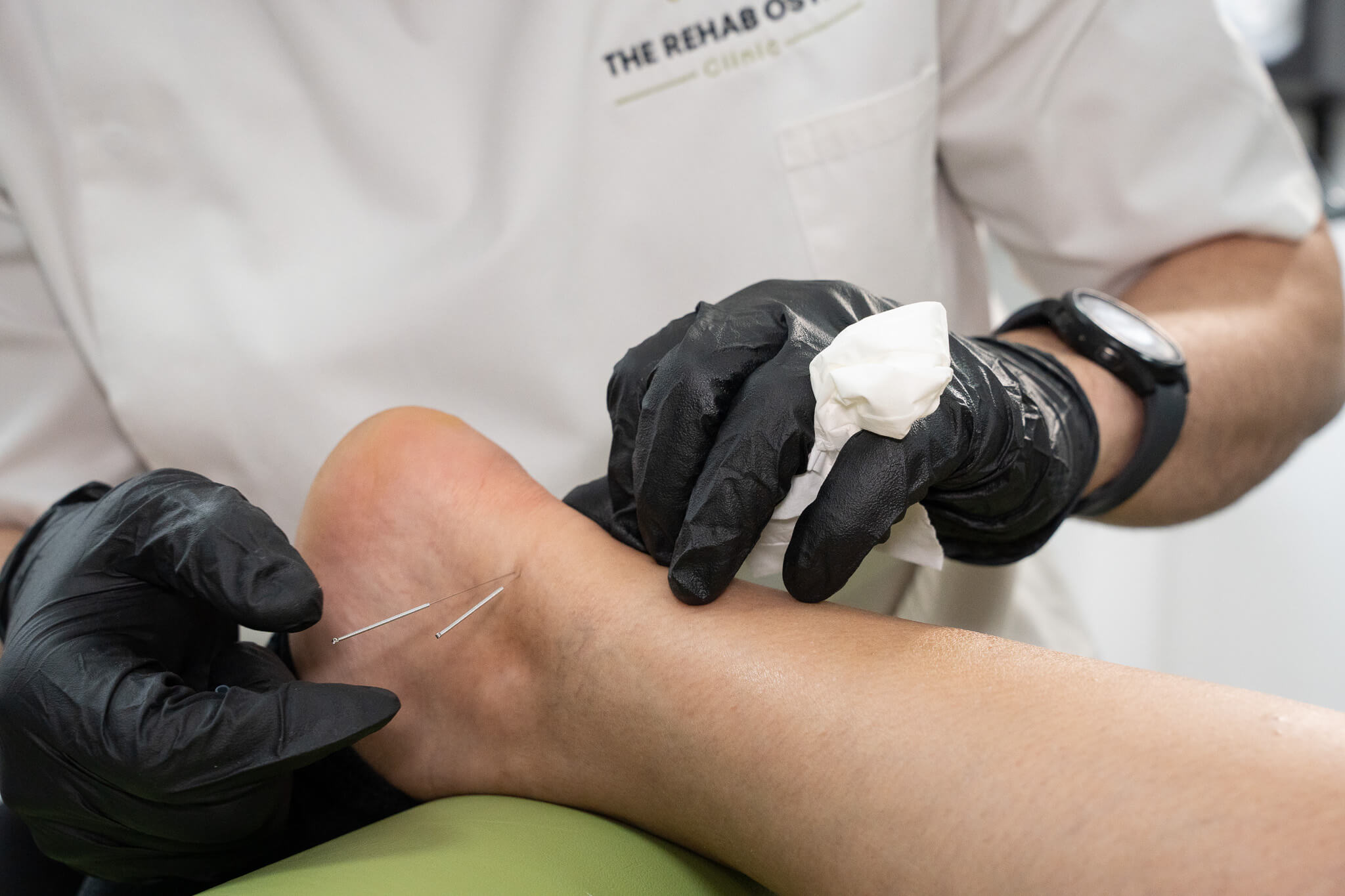 DSC06080 dry needling in the ankle and foot